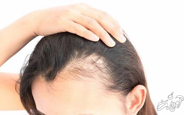 آویشن برای درمان ریزش مو  درمان ریزش مو